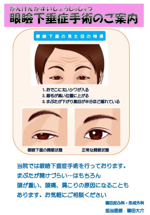 当院では、眼瞼下垂症手術を行っております。 まぶたがあけづらい・・・はもちろん頭が重い、頭痛、肩こりの原因になることもあります。 お気軽にご相談下さい。